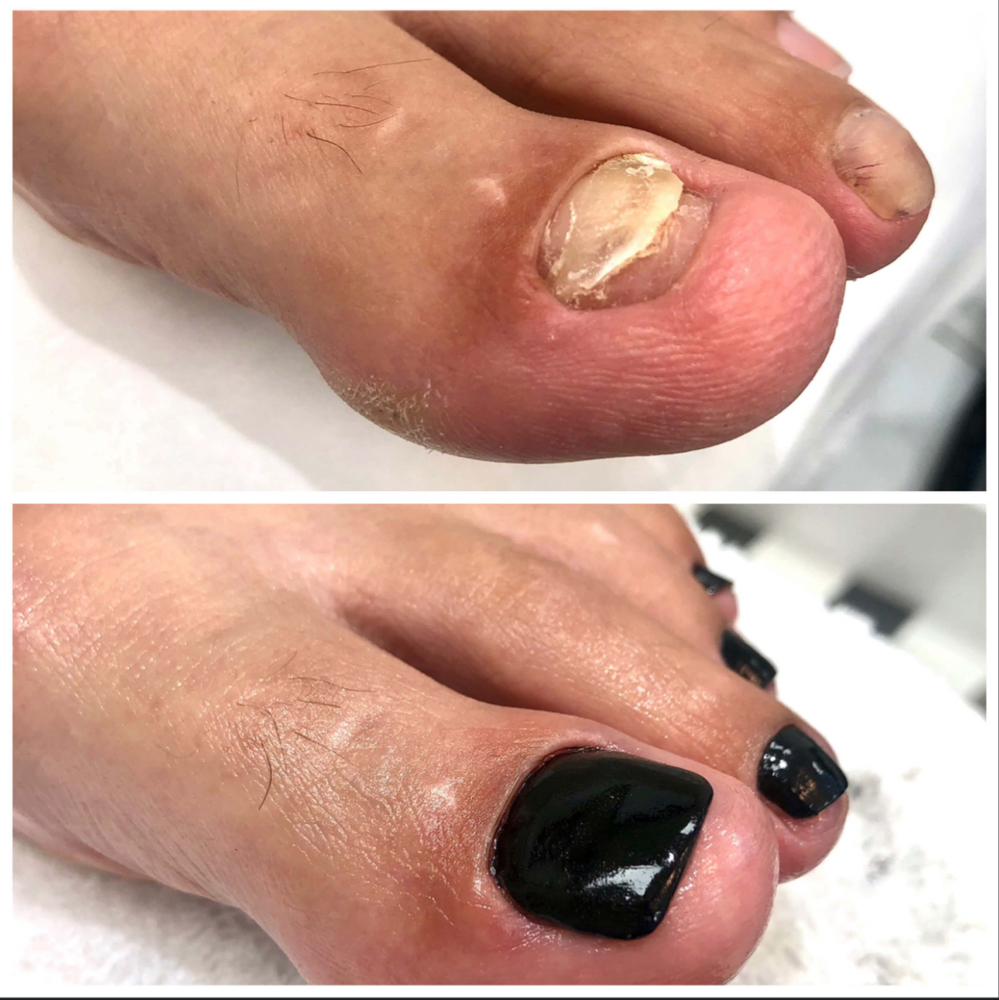 Nanoflex Toenail Reconstruction