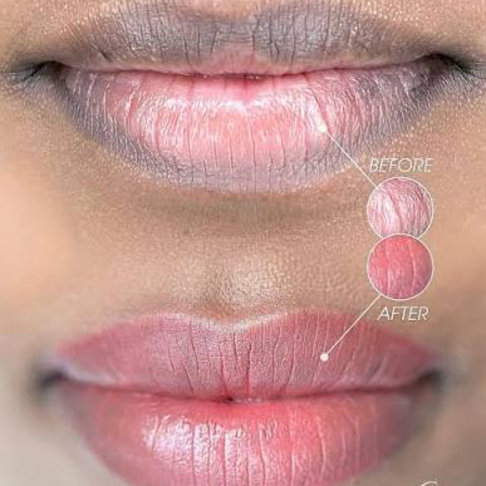 LIP NEUTRALIZATION (2nd SESSION ) at BEAUYBYJOJO PMU STUDIO in Plainfield, IL