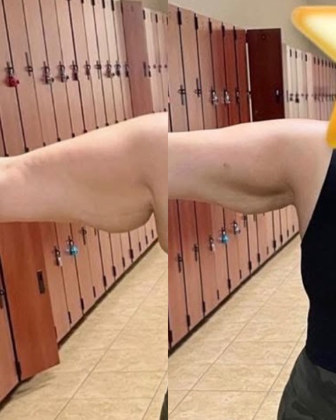 Lipo Dissolve Arms at Glowtox Haus in San Antonio, TX