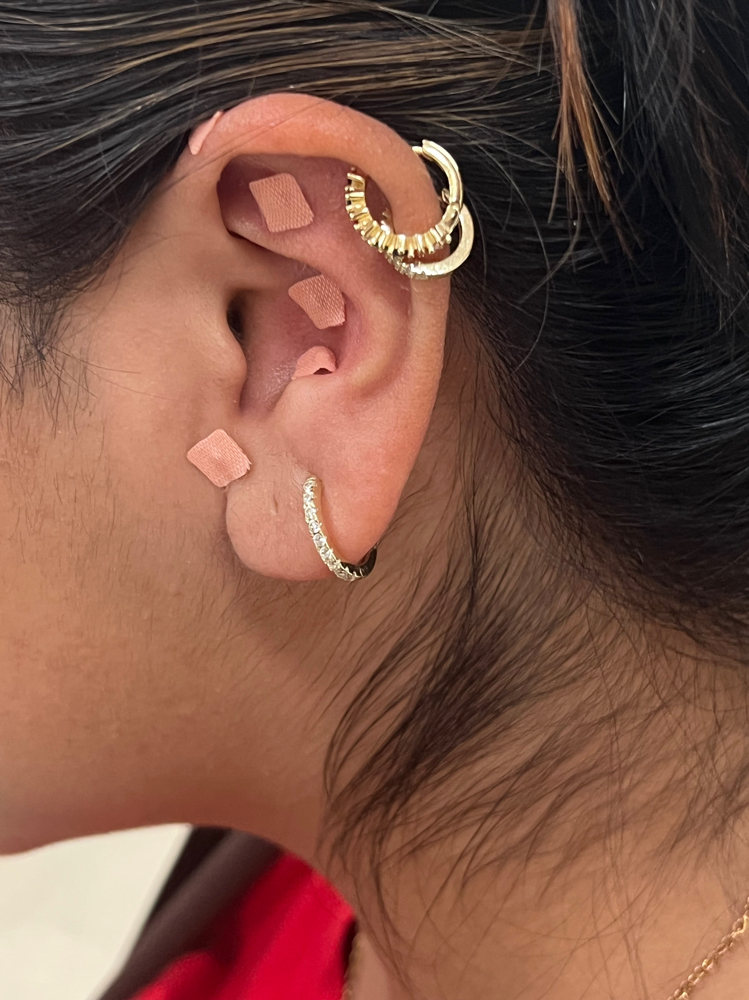 Ear Seeding
