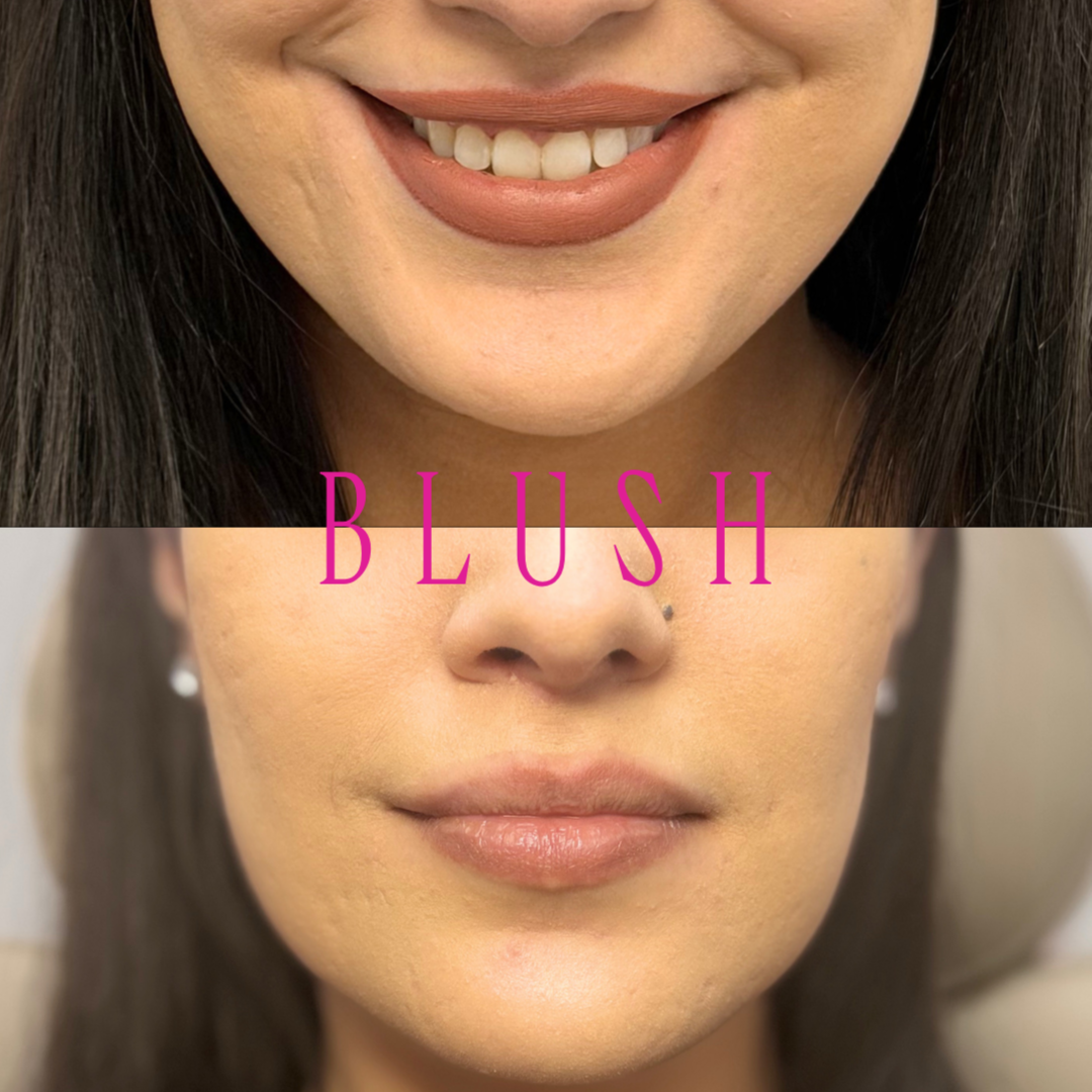 Masseter Toxin at BLUSH Aesthetics LLC in Laredo, TX
