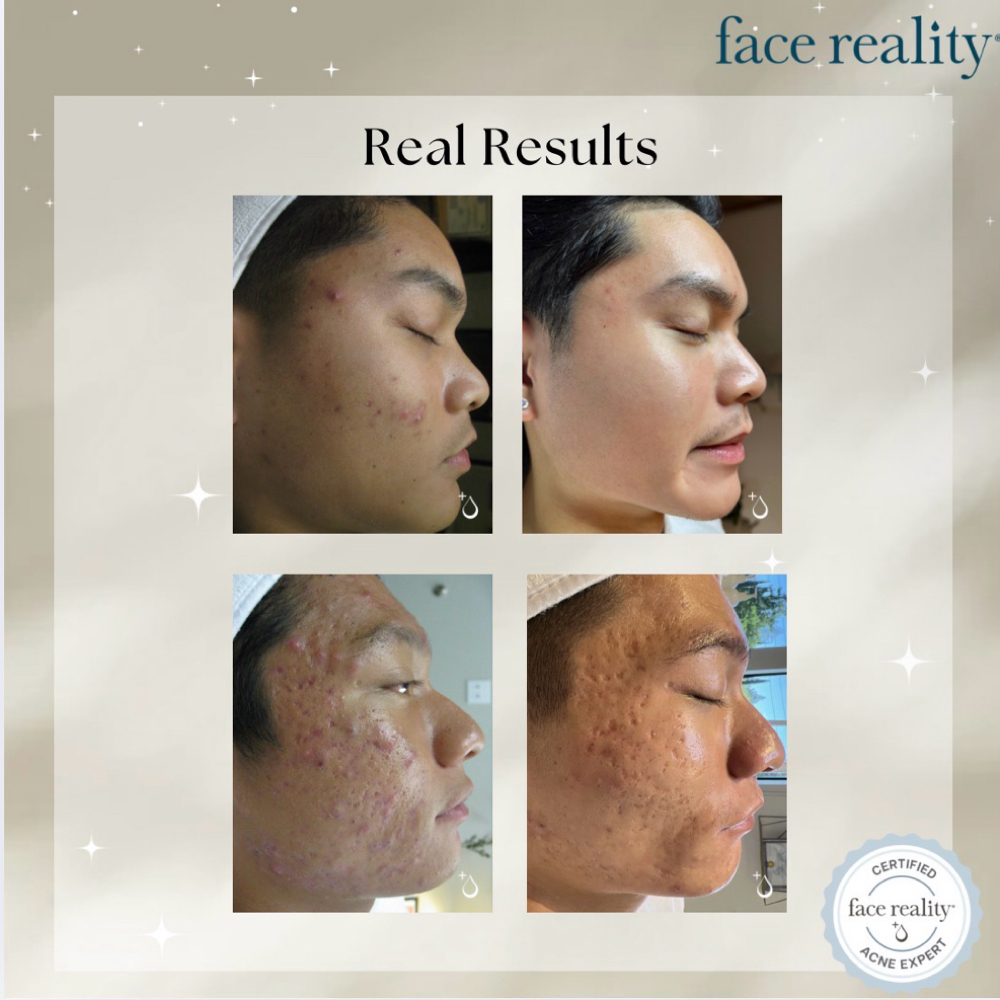 Acne Bootcamp Consult + Treatment 1 at Jemm Esthetics in Moreno Valley, CA
