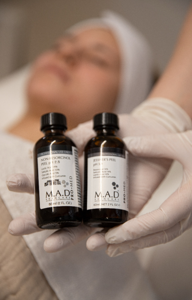 Chemical peel