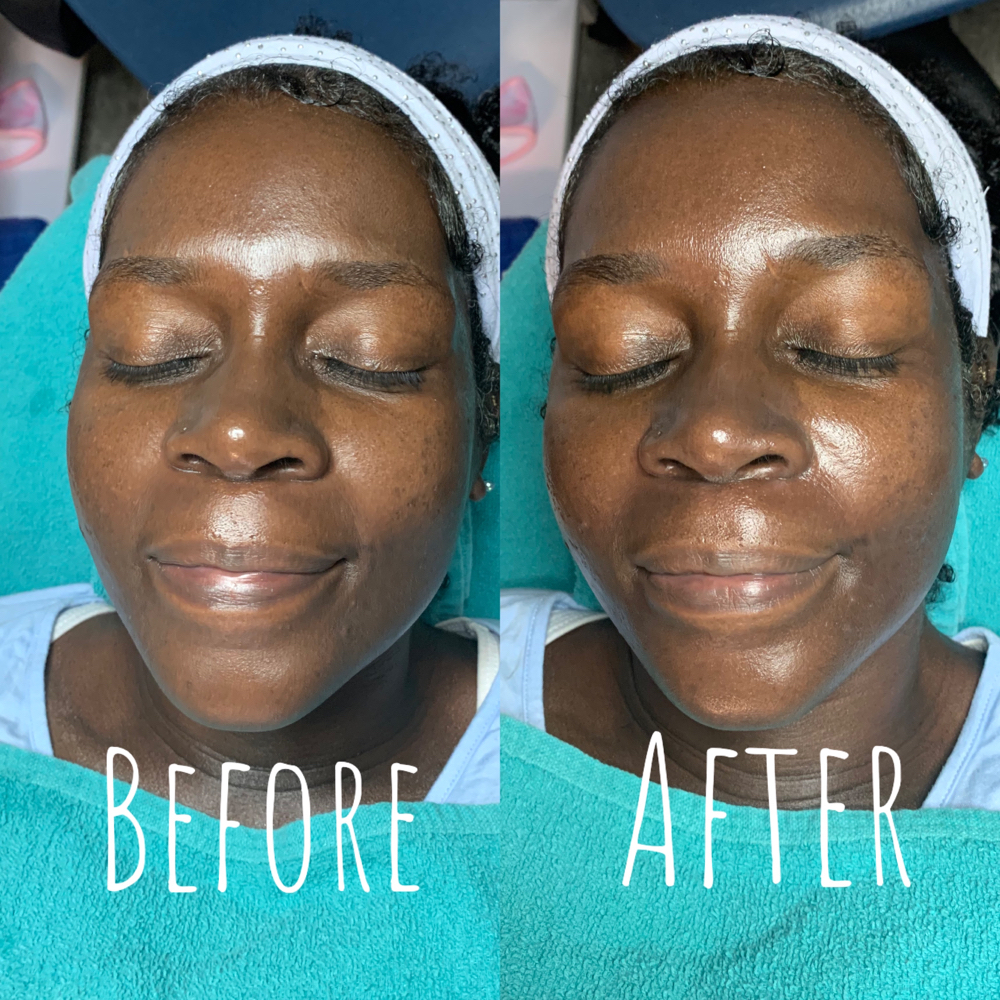 Microdermabrasion Facial