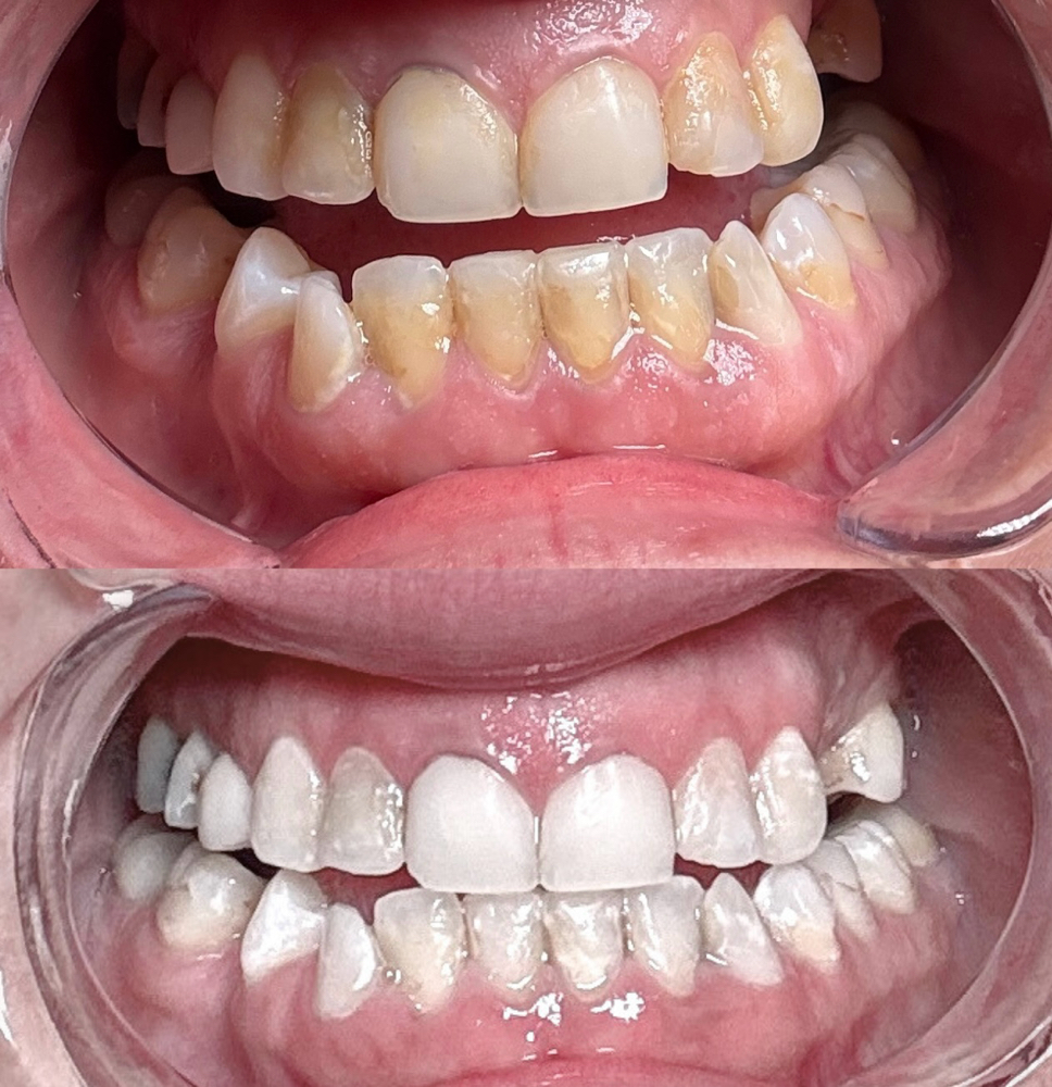 Luxe Whitening