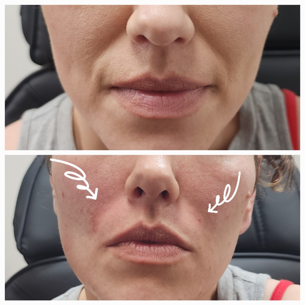 Nasolabial Filler