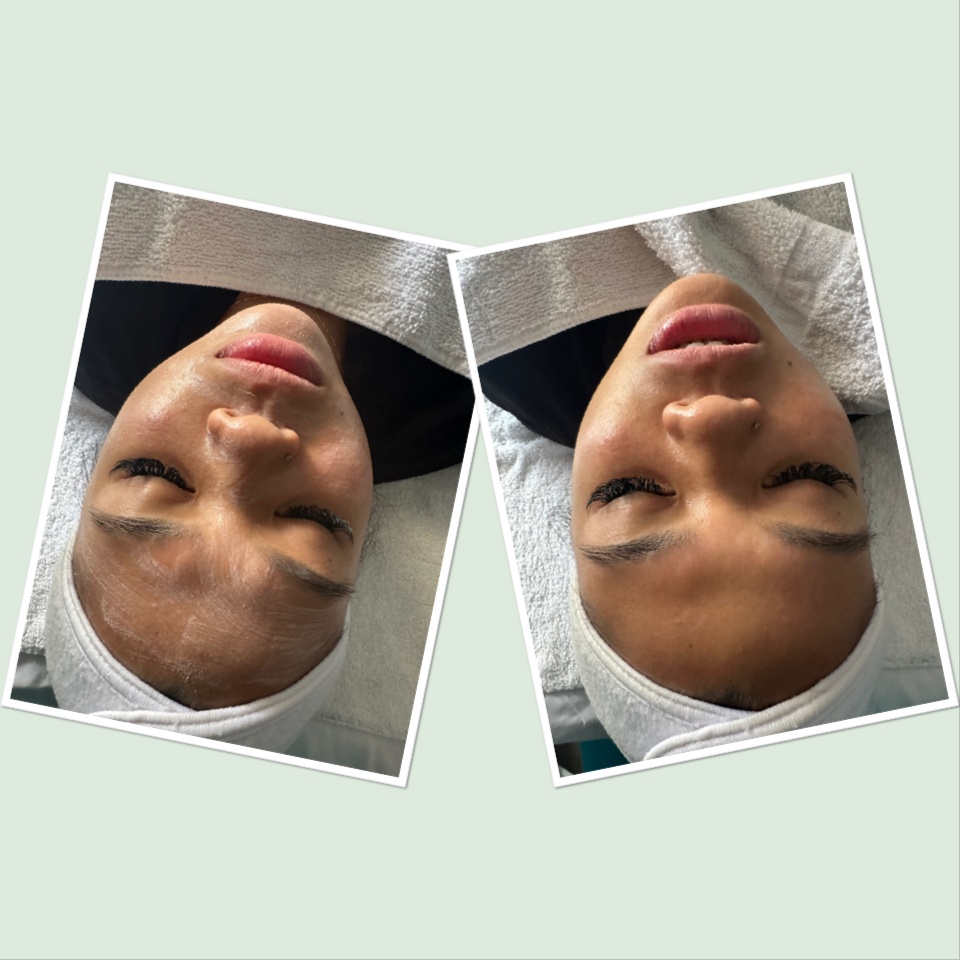 SiMonet Customized Chemical Peel at SiMonet Skincare in Virginia Beach, VA