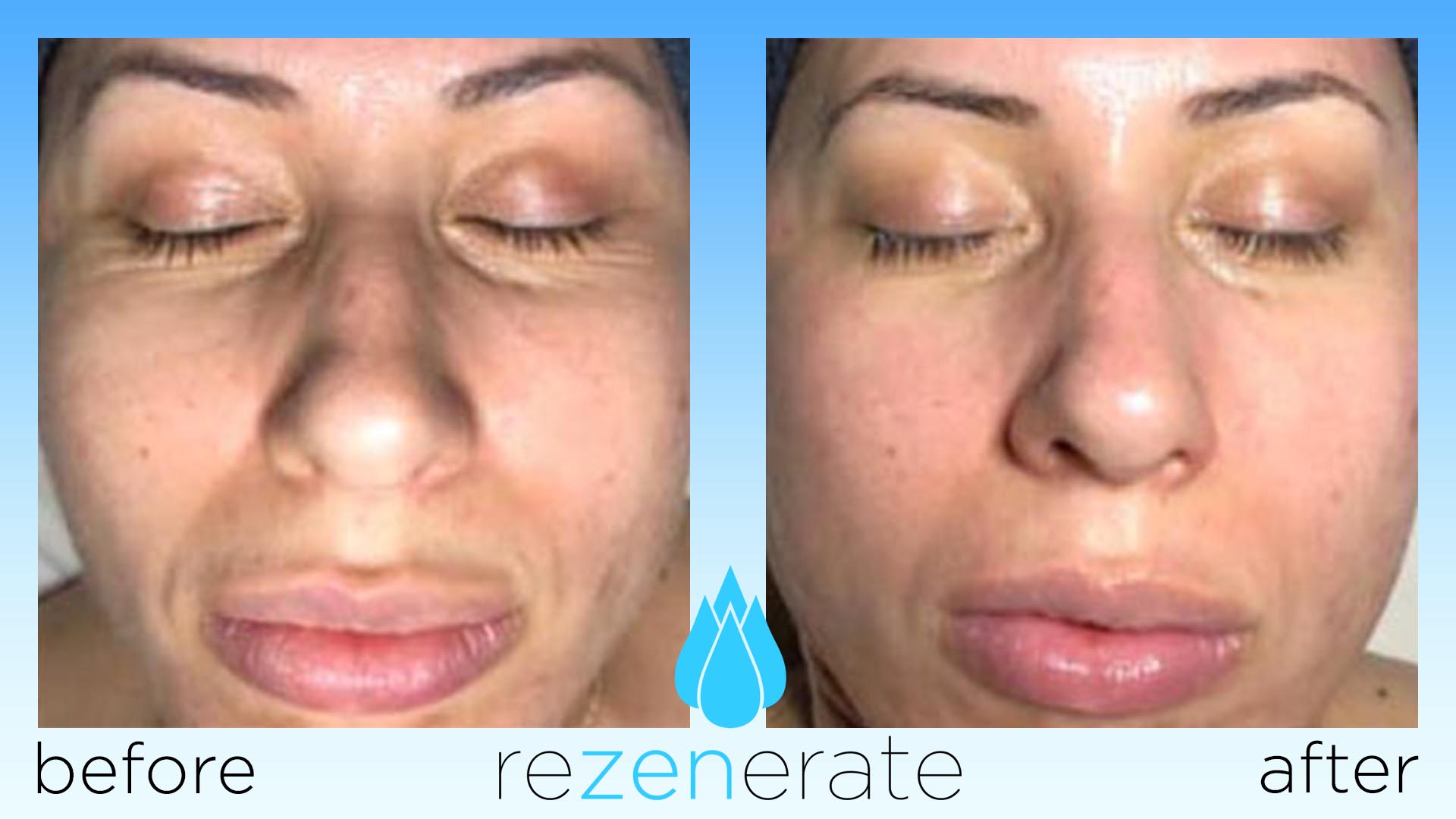 Rezenerate NanoFacial