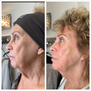 GROWTH FACTORS/PDRN at Marco Island Aesthetics