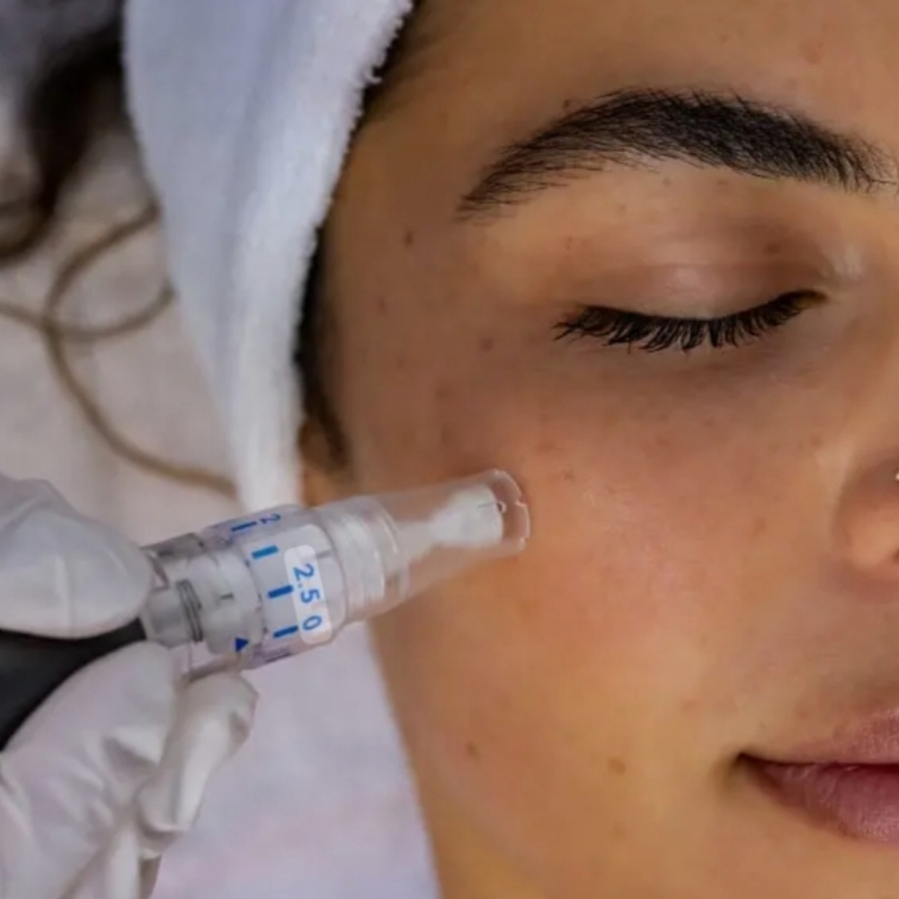 Microneedle with PRP - Face & Neck at Elite IV and Wellness in Cerritos, CA