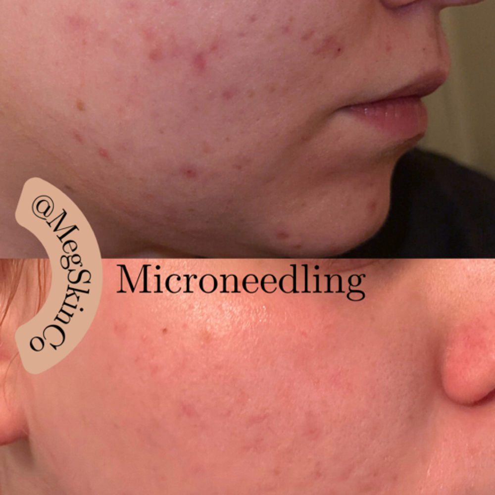 Microneedling Treatment at Meg Skin Co. in Huntersville, NC