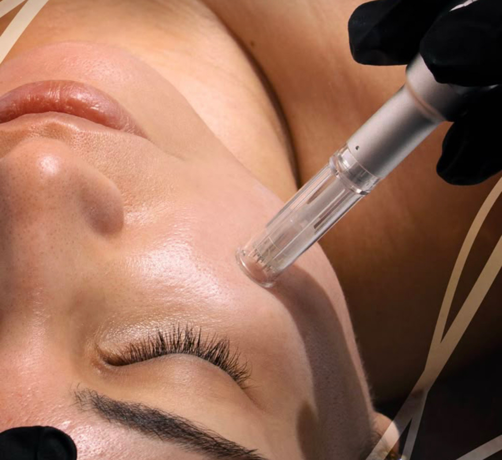 Microneedling Treatment