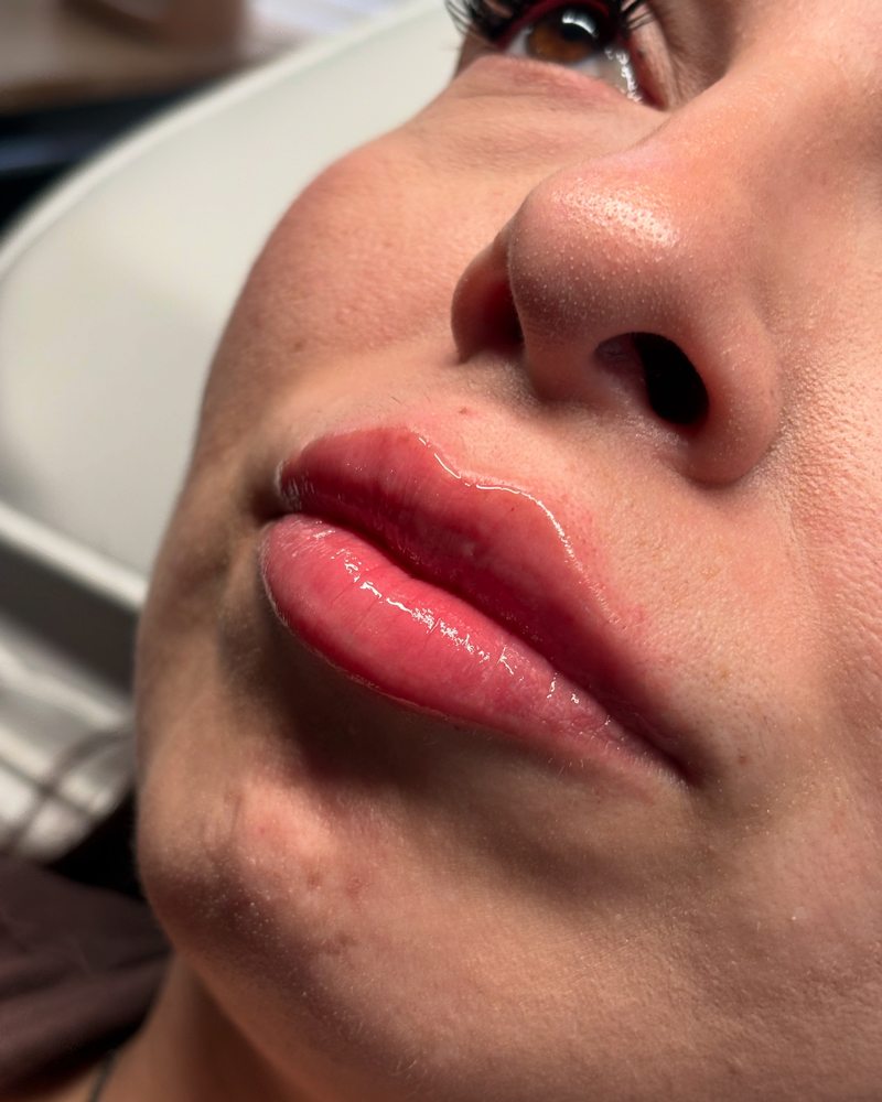 Kysse Full Syringe at Aura Skin x Marissa in Alice, TX