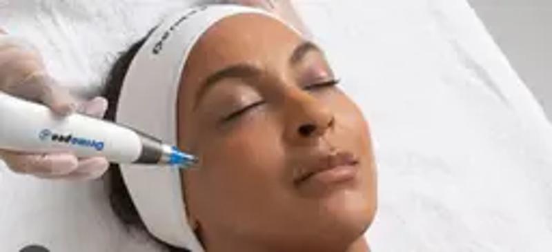 ✨ SALE Microneedling