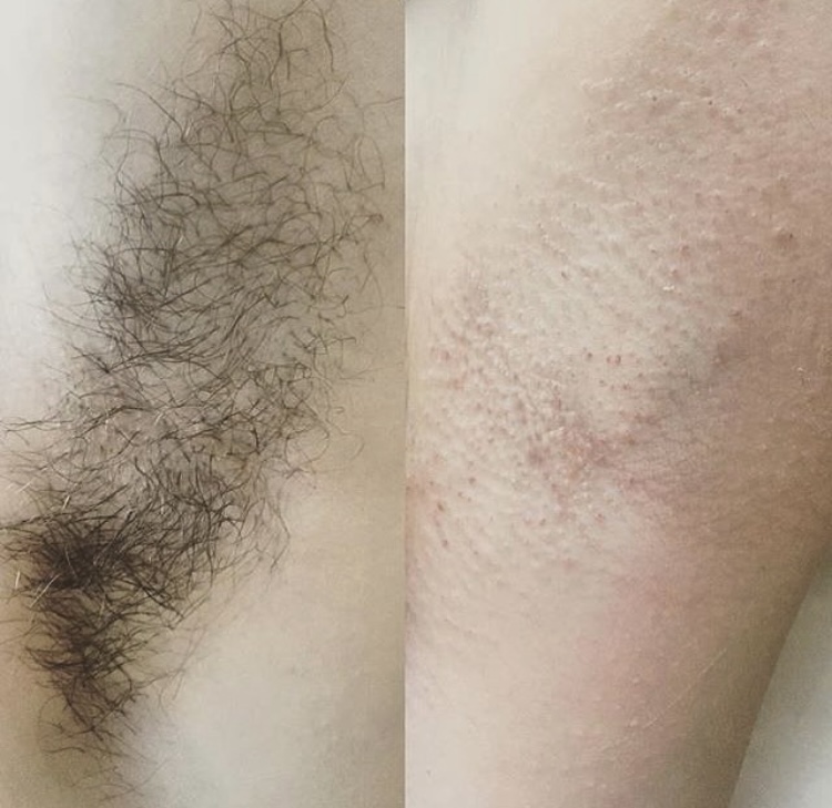 Underarm