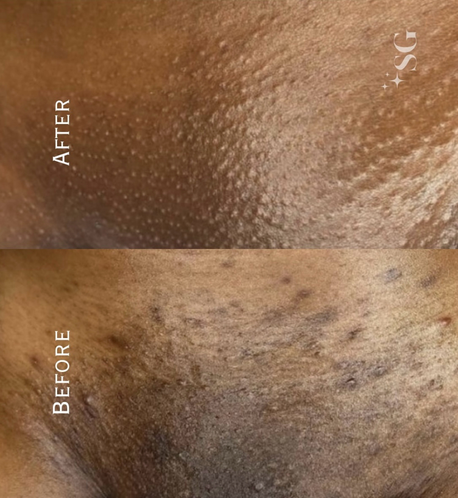 BioRePeel for Intimate Area