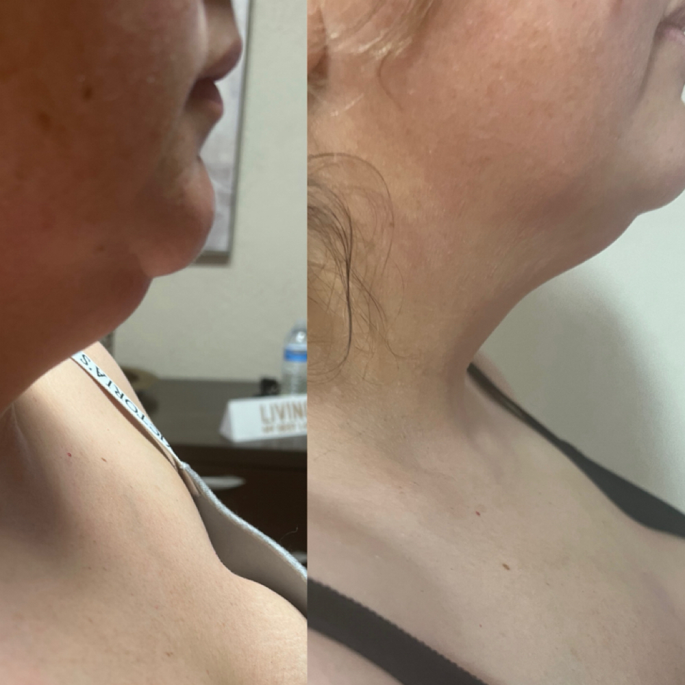 Radio Frequency (RF) Chin at Skin&Sculpt in Phoenix, AZ