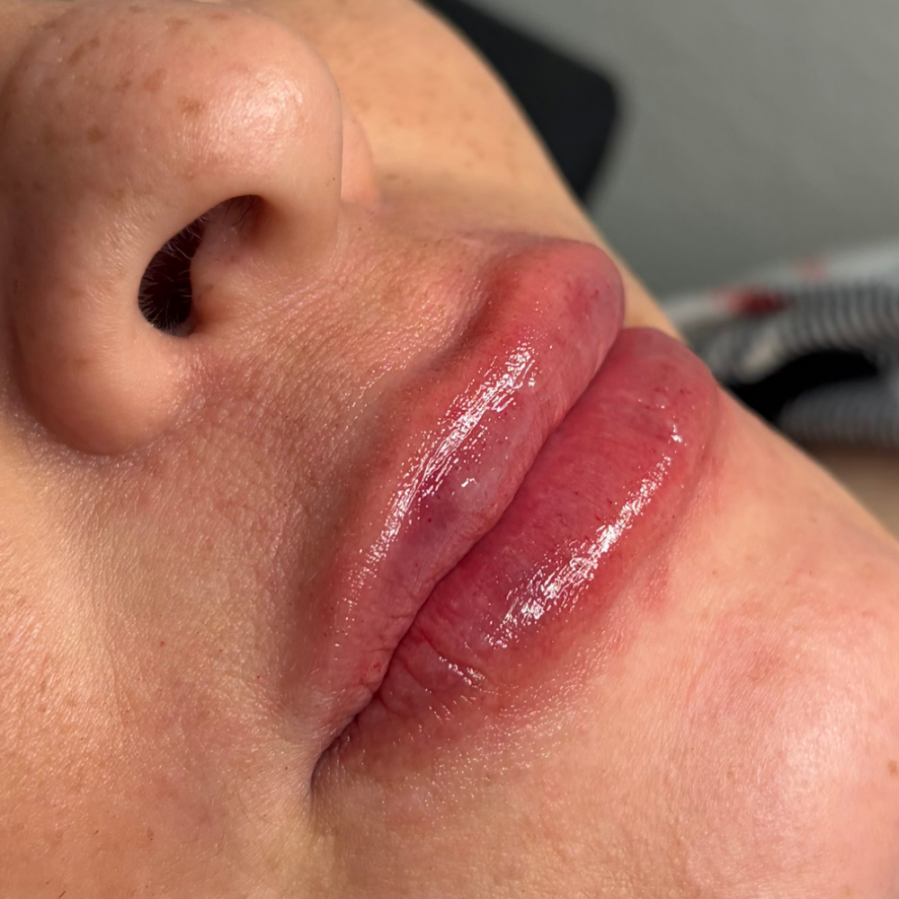 1.5ml Filler at Punchy Pouts & Esthetics in Amarillo, TX