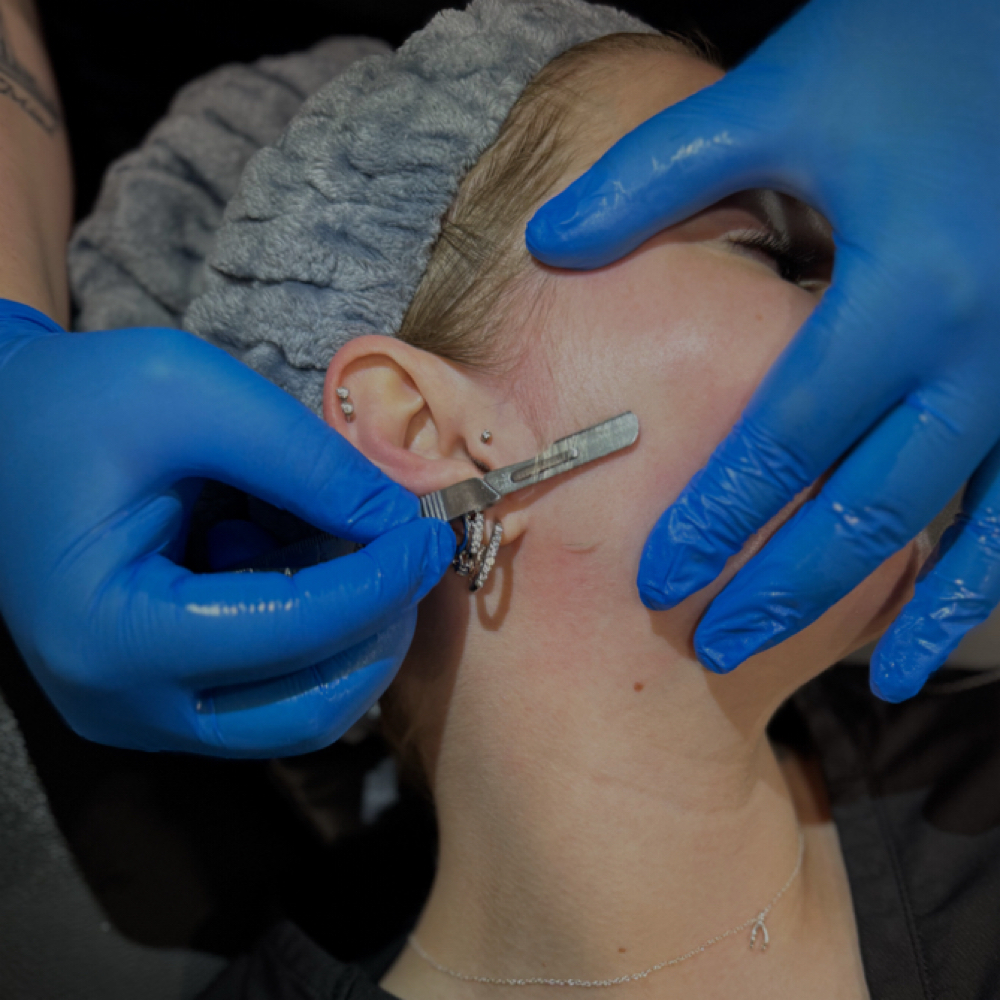 Dermaplane Facial at Skin by Summer Lee in Waynesboro, VA