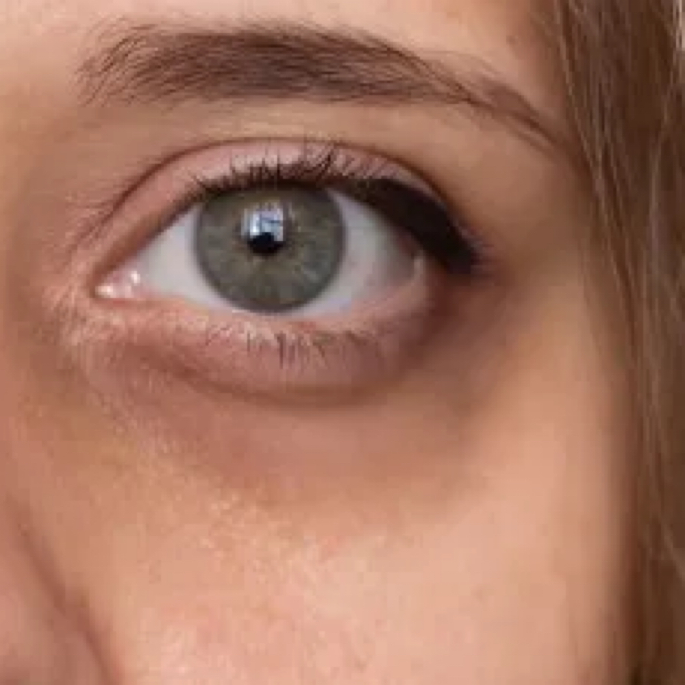 Under Eye Rejuvenation Treatment at Leidy Cornelio Spa in Aurora, CO