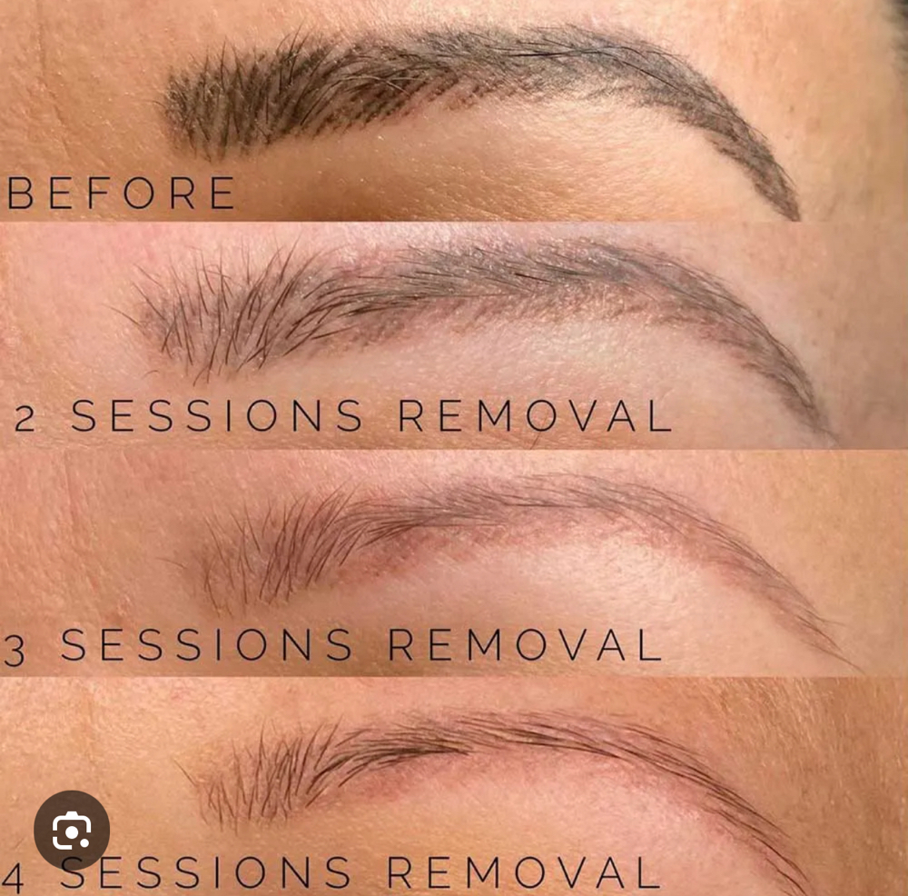 Eyebrow Tattoo Removal
