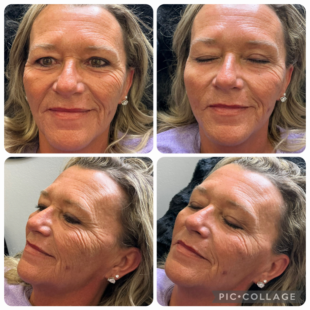 Facial Balancing at Alt Boutique & Aesthetics | Nurse Injector in Hereford, TX