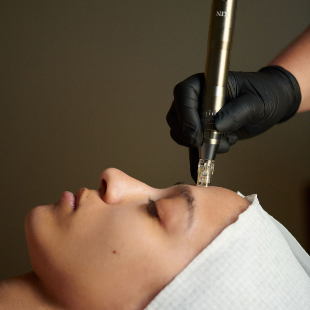Microneedling at Hygge Skin in Miami Fl, FL