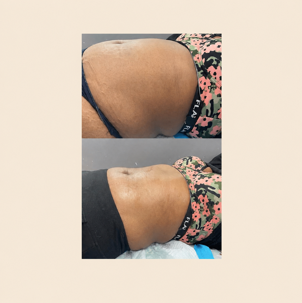 Waist Sculpt - 6 Session Package at BODIEDBYNICKEI LLC in The Bronx, NY
