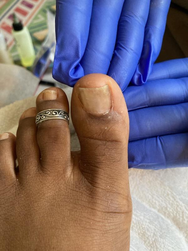 Pedicure with Toenail Restoration