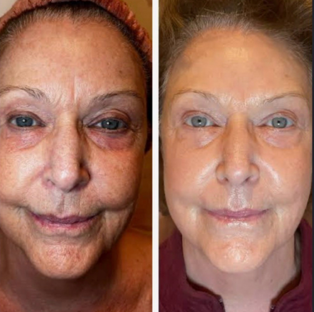 Age-Defy Sculpt & Lift Glow Facial at Rejuva Glow Beauty in Bethesda, MD
