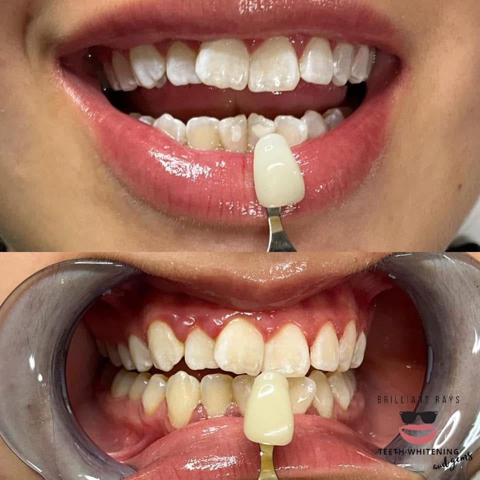 Teeth Whitening at Peridot Studio in Lubbock, TX