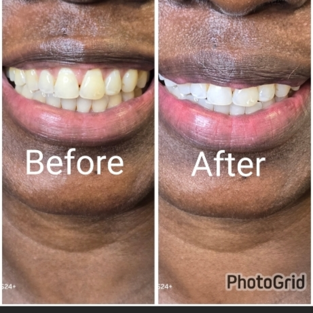 30min Teeth Whitening 🦷