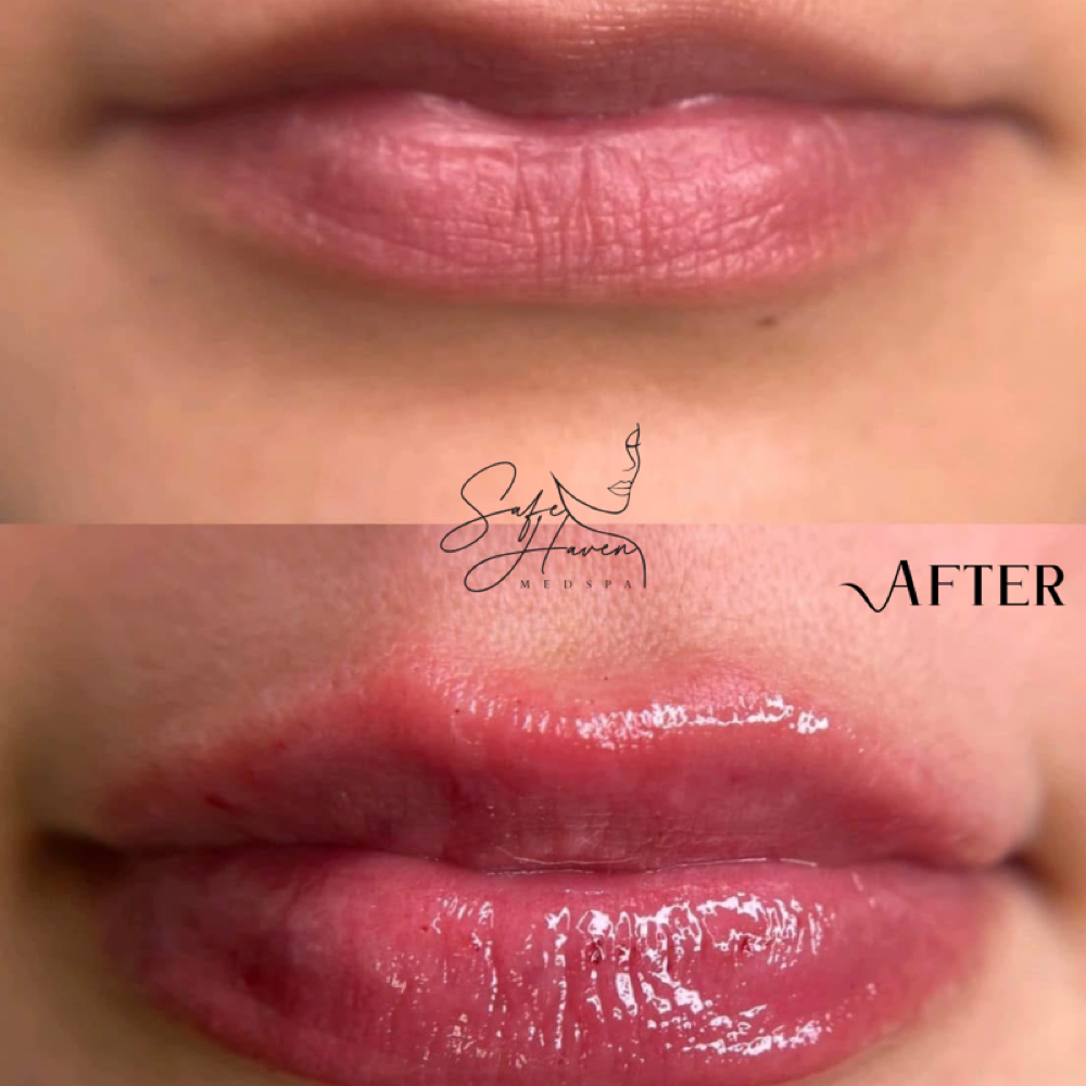 Lip Filler – Full Syringe (1.0 mL) at Safe Haven MedSpa in McAllen, TX
