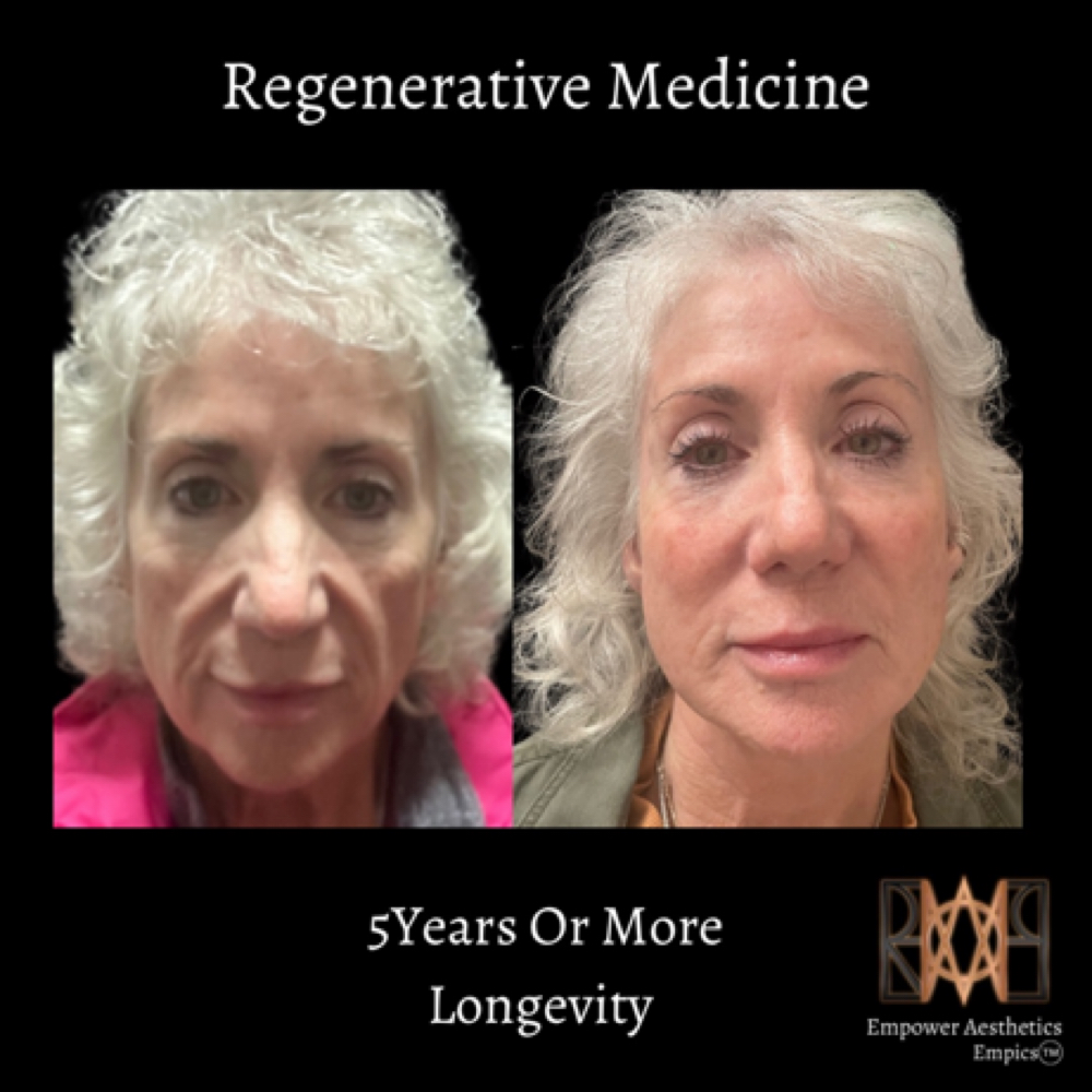 Bellafill Regenerative Medicine at Empower Aesthetics in Canyon Lake, TX