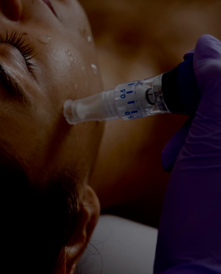 Skin Pen Microneedling Treatm...