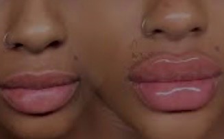 0.5 Hyaluronic Lip