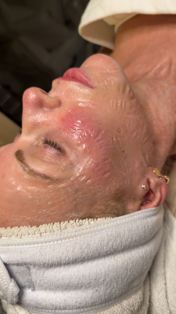 Peptide Botox Treatment