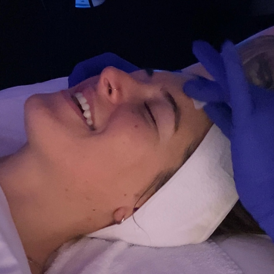 Add On - Light Chemical Peel at Arcadia Esthetics in Plymouth Meeting, PA
