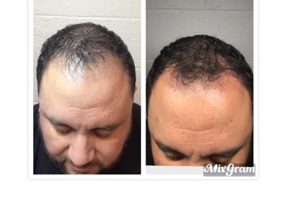 DeRive Hair Treatment - Full 3 Pack