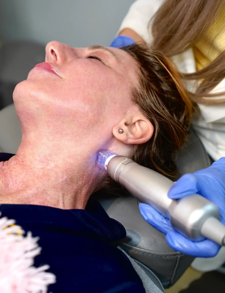 Microneedling (Face+Neck+chest)