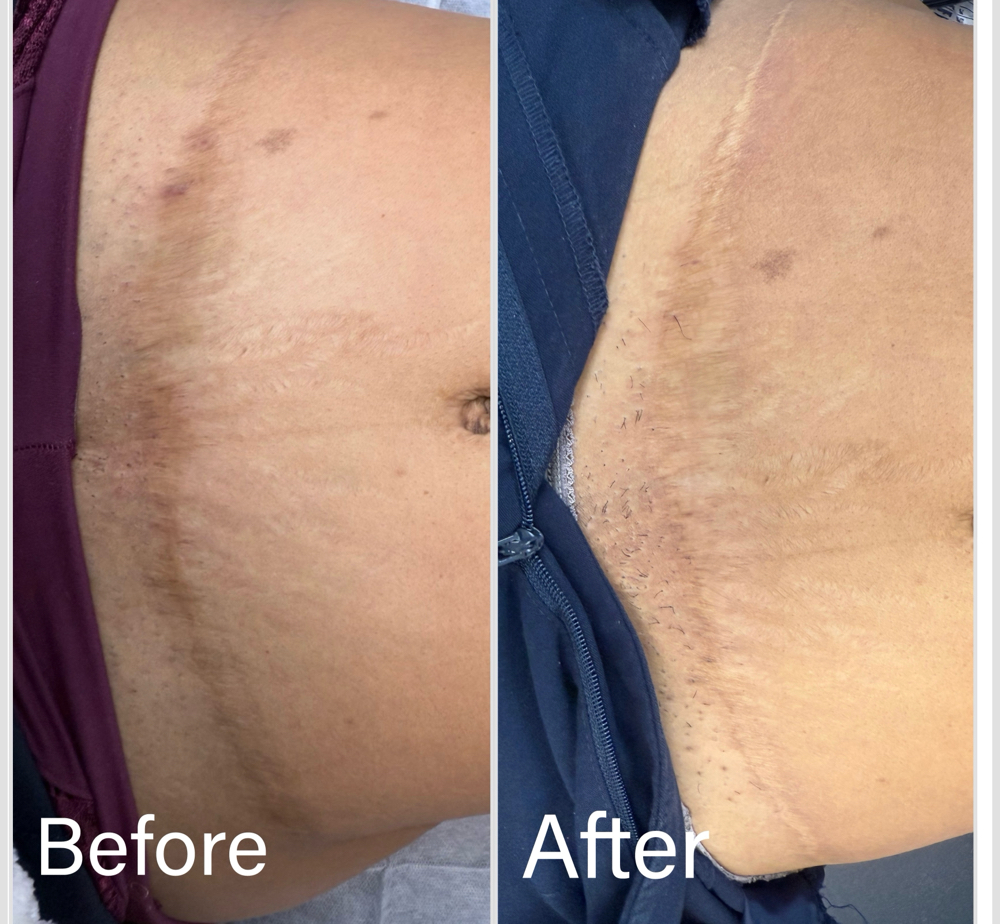 Scar Powder Lightning at Ink Beauty Studio in McAllen, TX