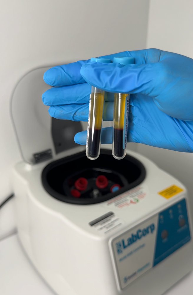 PRP microneedling