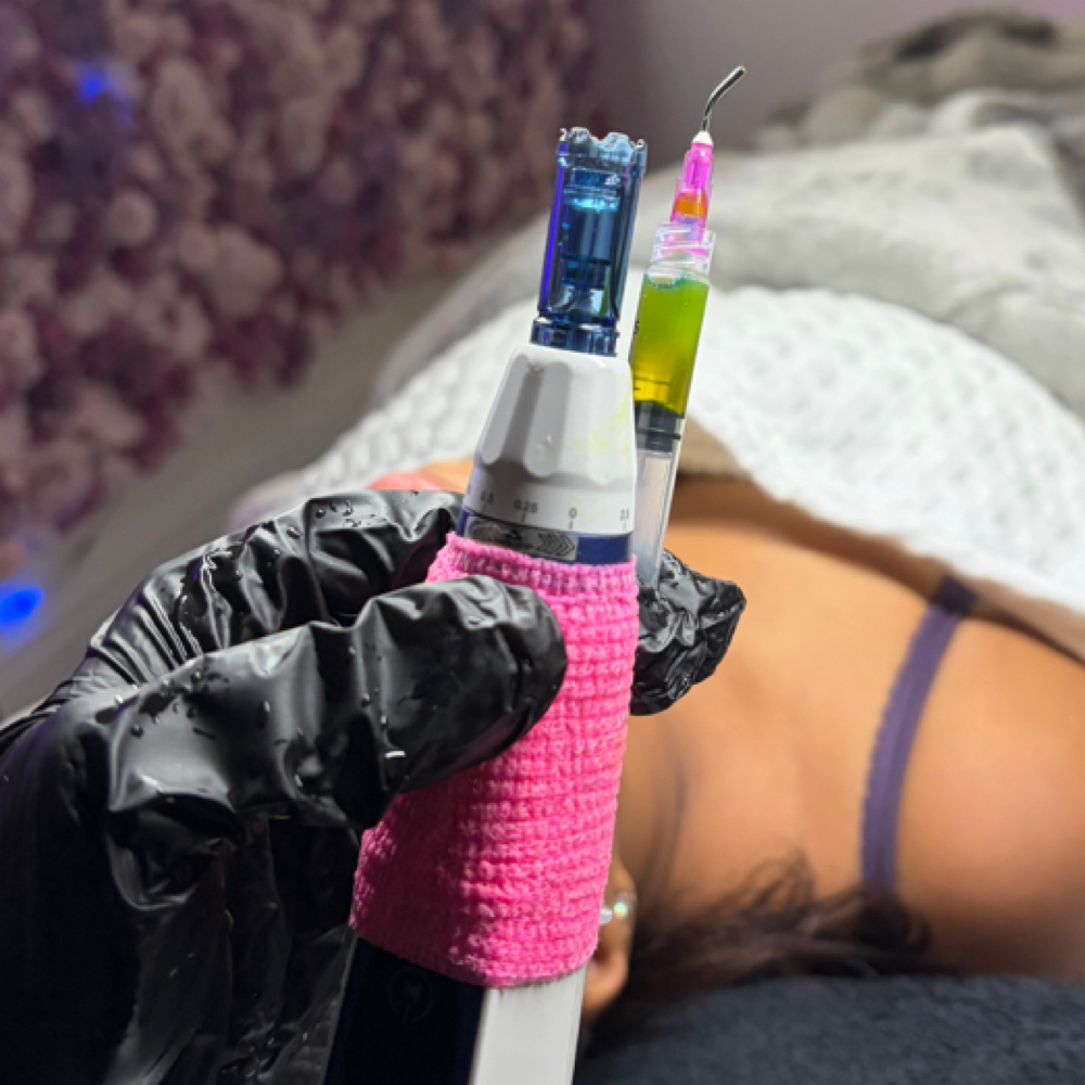 BioRePeel + Microneedling