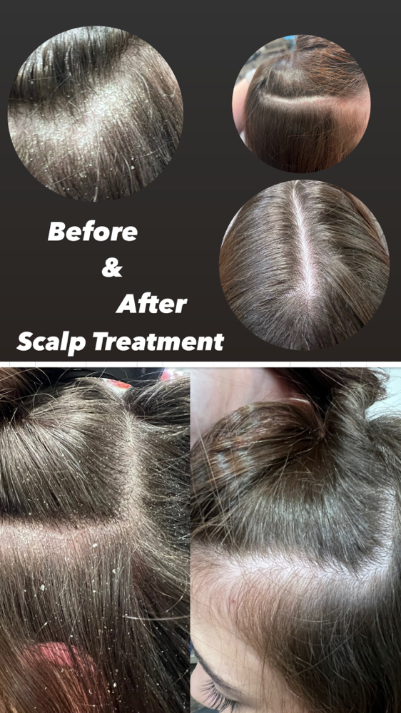 Scalp Treatment