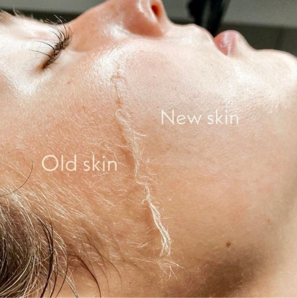 Dermaplane (Removes Peach Fuzz) at Serene Studios in Sigel, IL