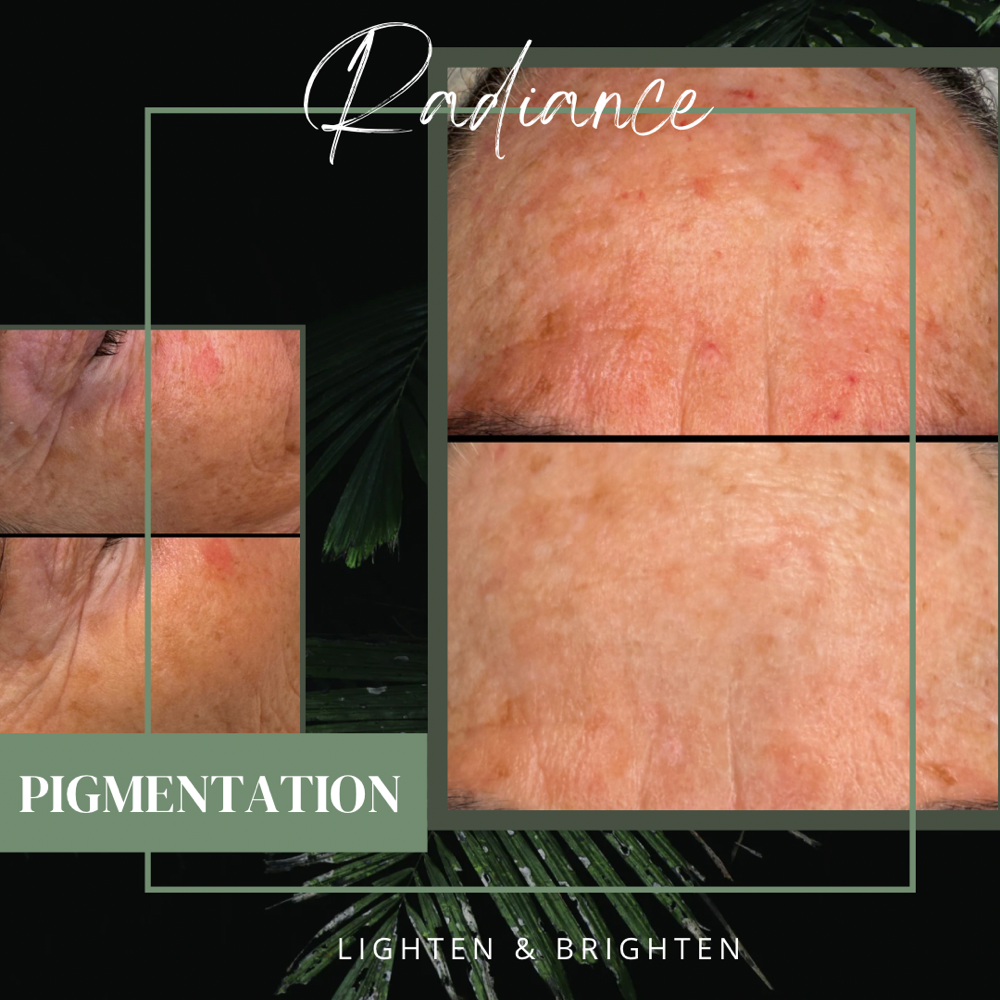 Radiance (Pigmentation)