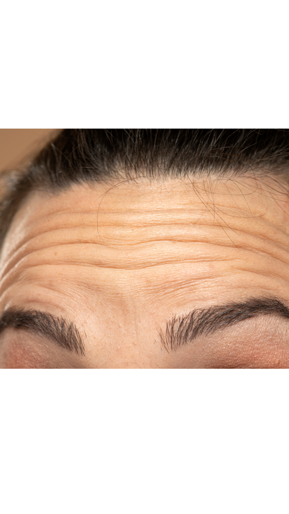 Forehead & Frown Lines W/ Tox