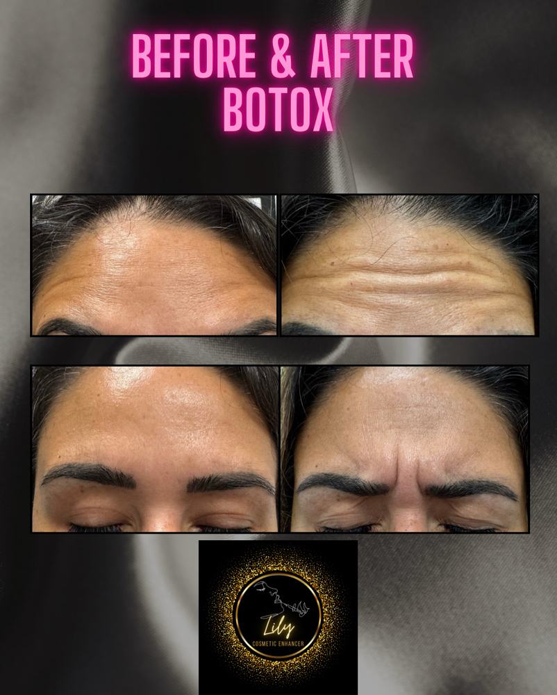 Forehead & Frown Lines W/ Tox