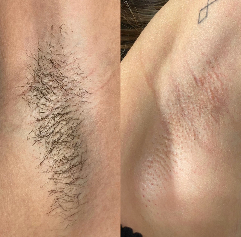 Underarm Wax