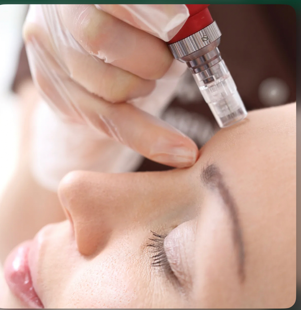 Microneedling